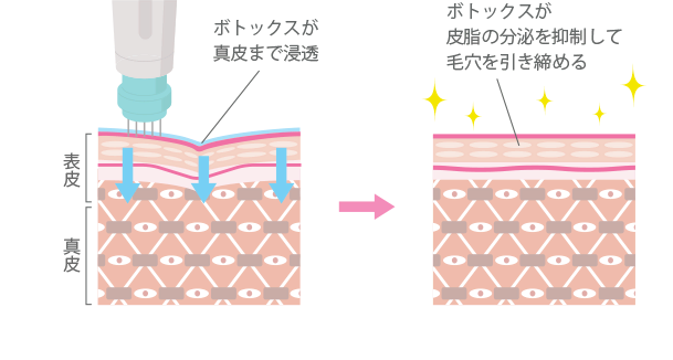 マイクロボトックス/スキンボトックス(水光注射+ボトックス)