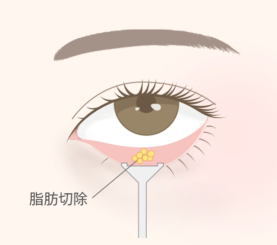 経結膜脱脂術の施術イメージ
