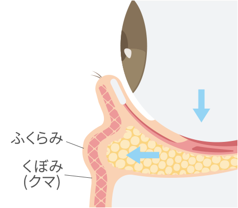 裏ハムラ法(経結膜的眼窩脂肪移動術)のイメージ