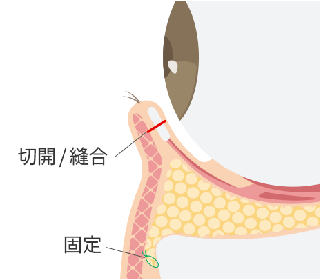 裏ハムラ法(経結膜的眼窩脂肪移動術)のイメージ