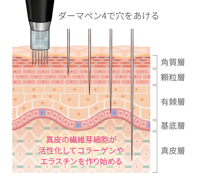ダーマペン4とは