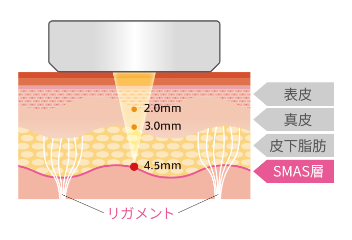 当院の採用機種ソノクイーン(SonoQueen)