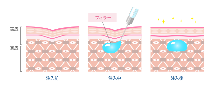 フィラー