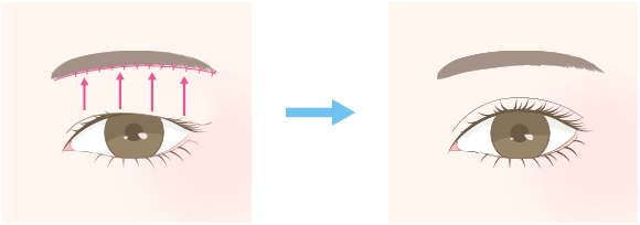 眼瞼下垂(がんけんかすい)手術との違い