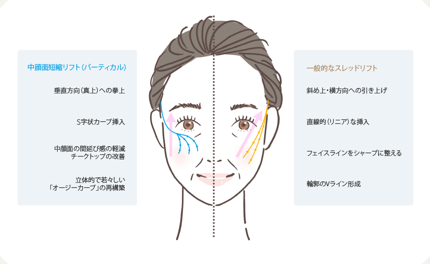 通常の糸リフトと「中顔面短縮リフト」の構造的な違い