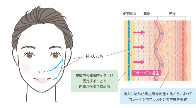 糸リフト(スレッドリフト)とは