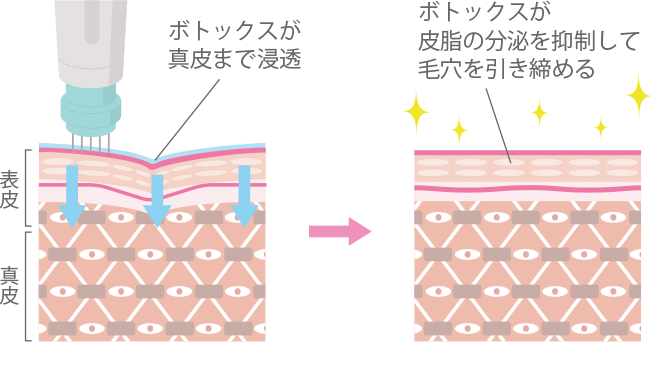 マイクロボトックス/スキンボトックス(水光注射+ボトックス)