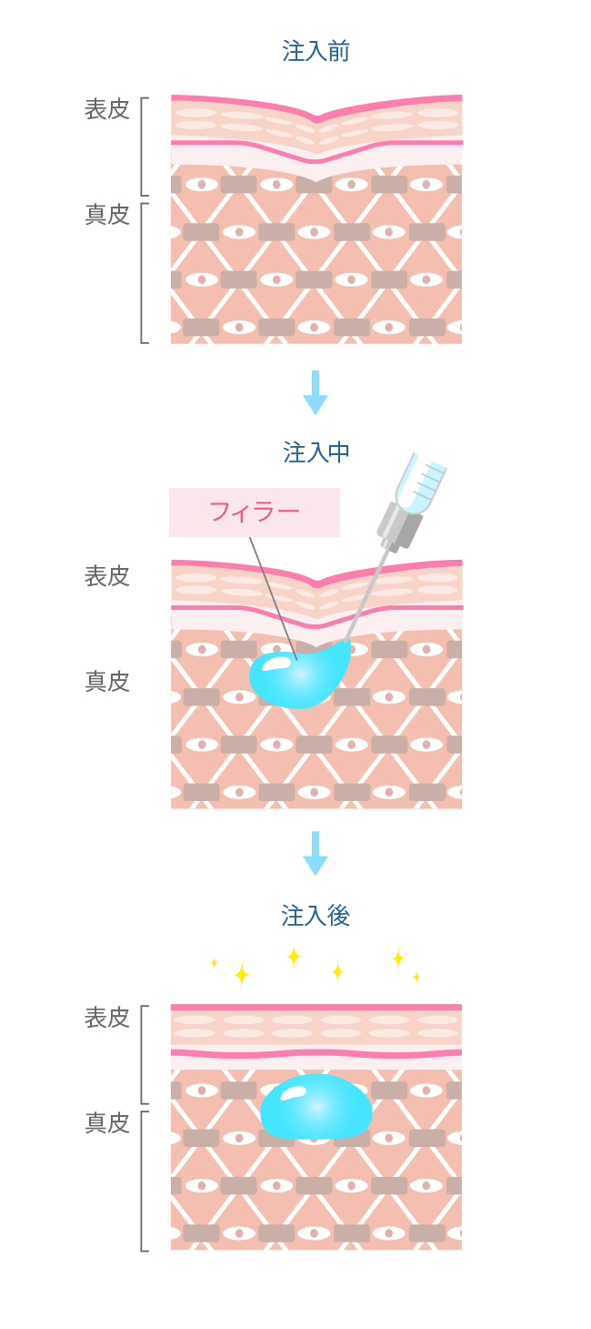 フィラー