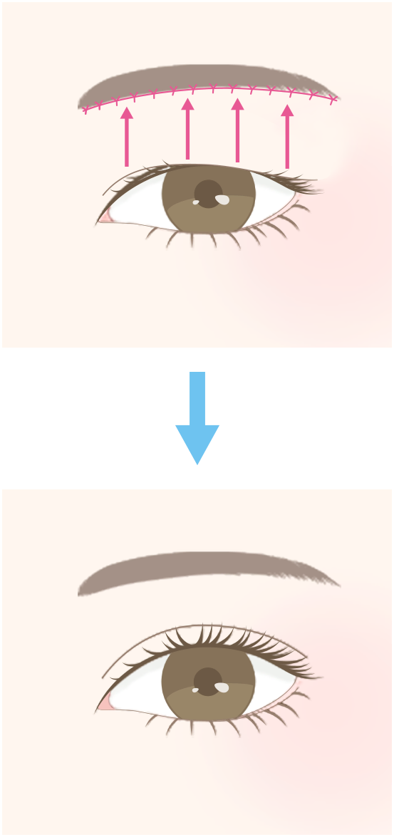 眼瞼下垂(がんけんかすい)手術との違い