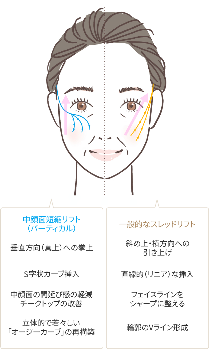 通常の糸リフトと「中顔面短縮リフト」の構造的な違い