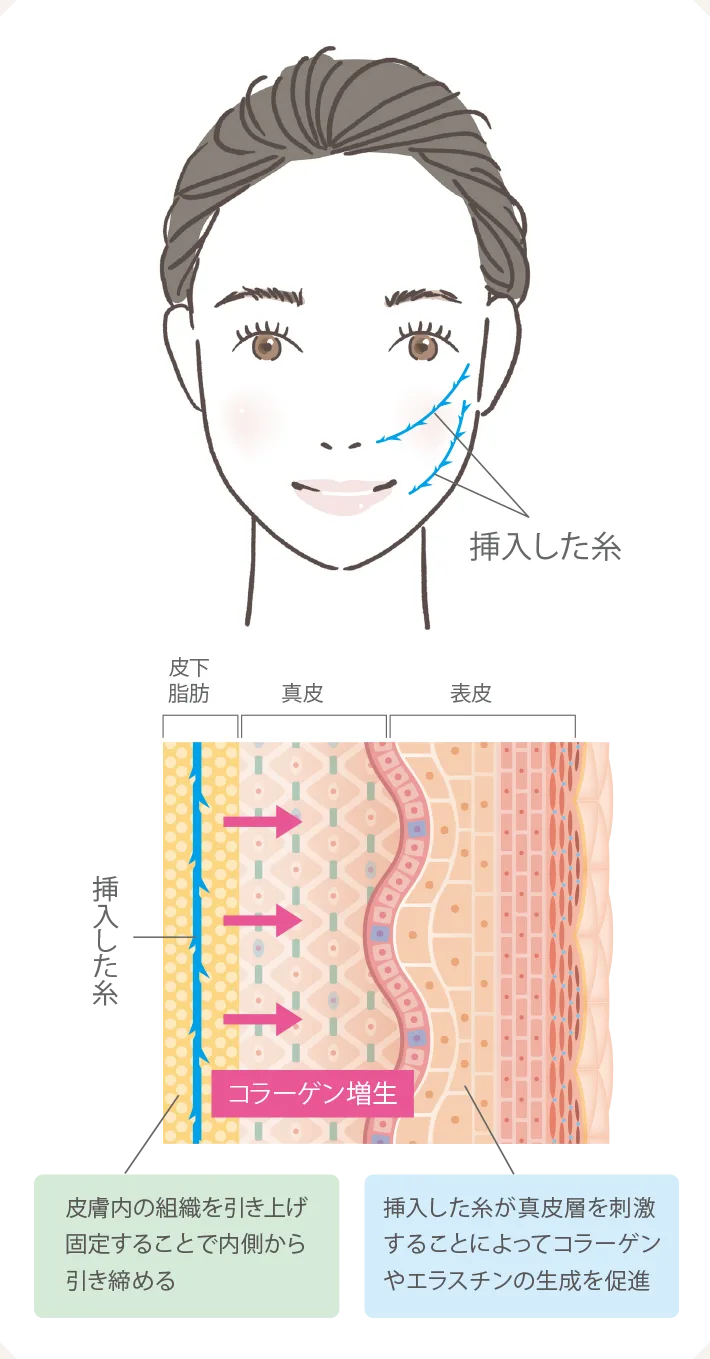 糸リフト(スレッドリフト)とは